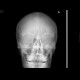 Skull fissure, epidural hematoma: X-ray - Plain radiograph